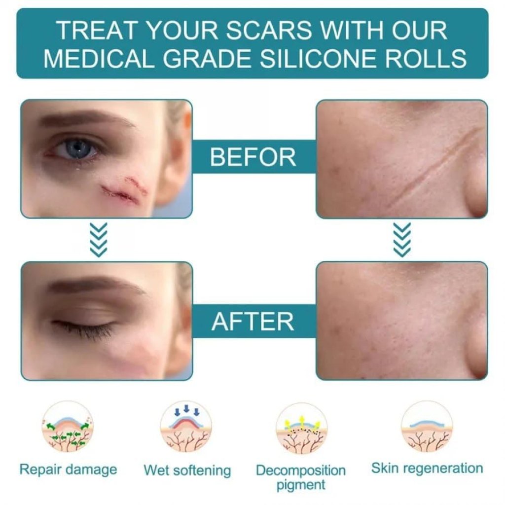 Medical Silicone Scar Removal Tape Roll | Advanced Keloid & C-Section Scar Treatment