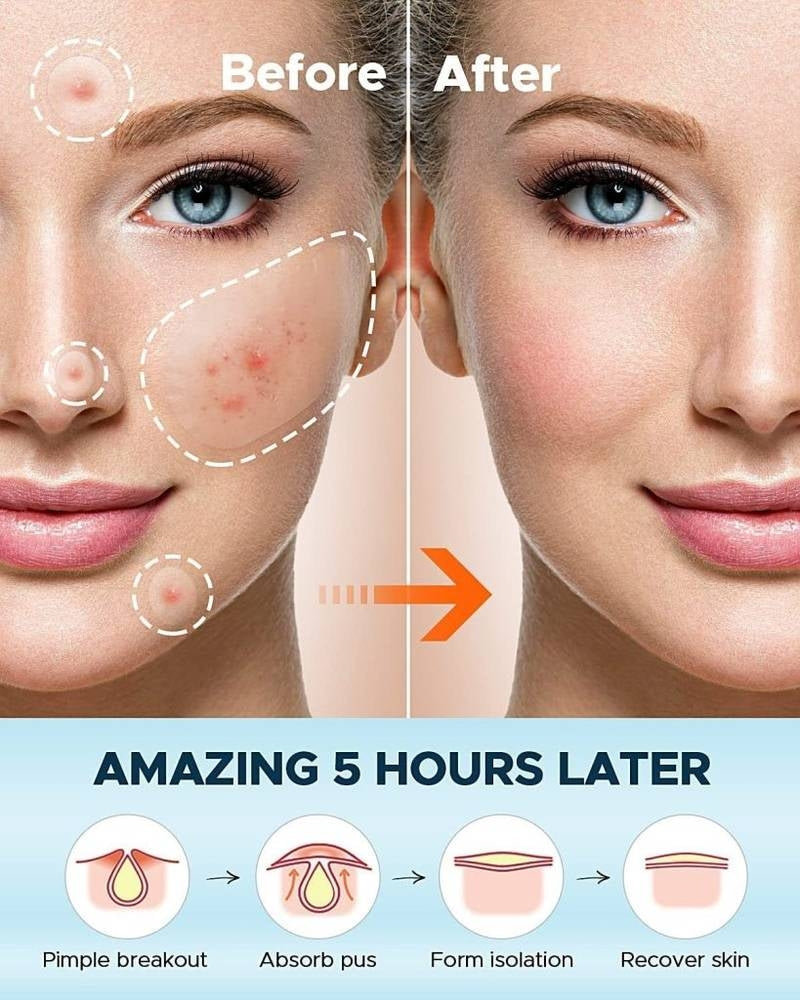 Before and after comparison of a woman's face with acne treatment, showing a clear skin improvement.