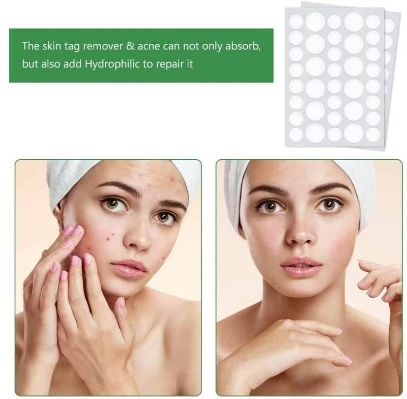 Before and after comparison of a woman's face with skin tags and acne, using a skin tag remover and acne product.